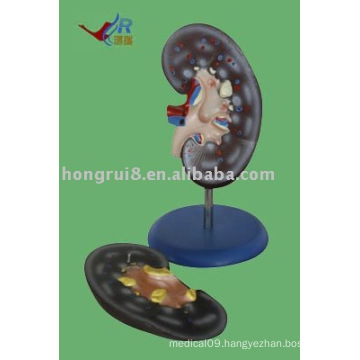 Kidney Anatomy Model, a Kidney model (2 piece )